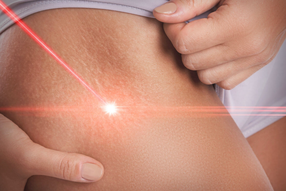 The Low-Down on Zerona Treatments